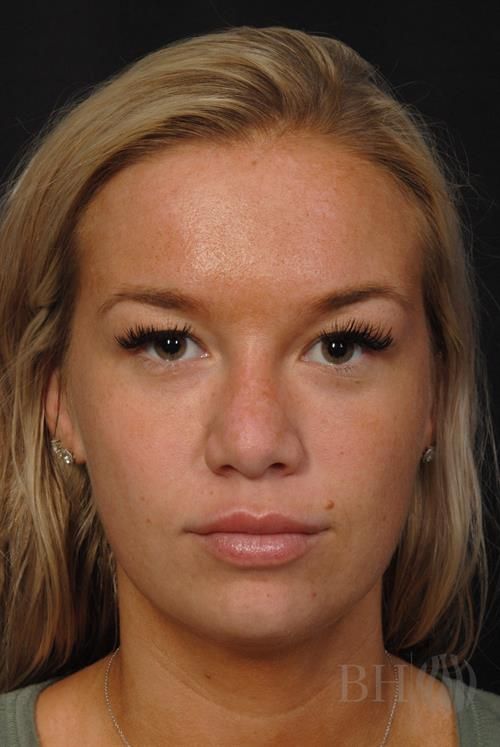 Rhinoplasty Before & After