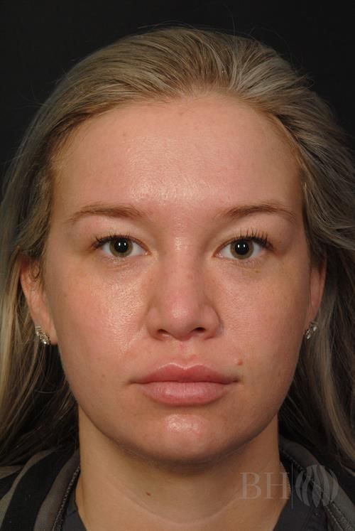 Rhinoplasty Before & After