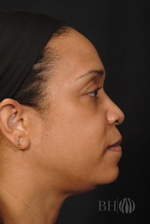 Rhinoplasty Before & After