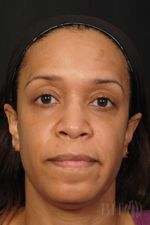 Rhinoplasty Before & After