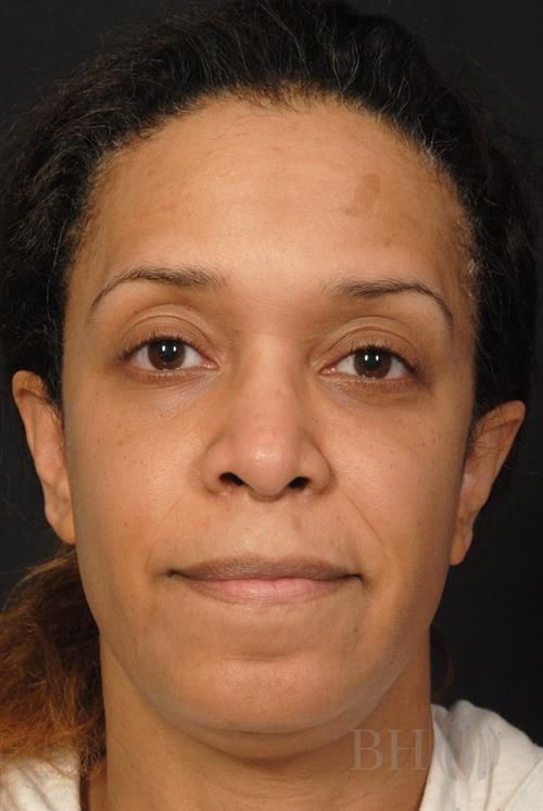 Rhinoplasty Before & After