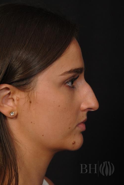 Rhinoplasty Before & After