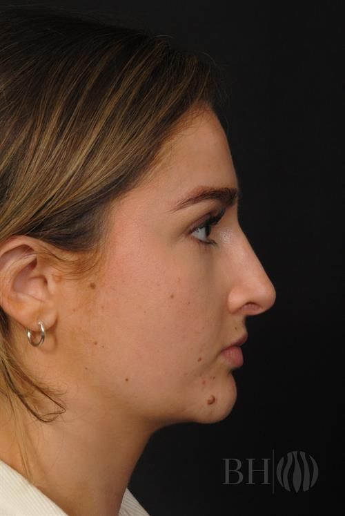 Rhinoplasty Before & After