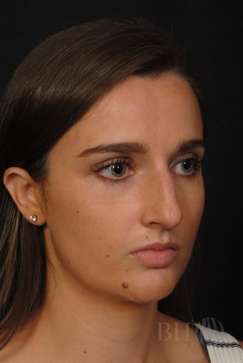 Rhinoplasty Before & After