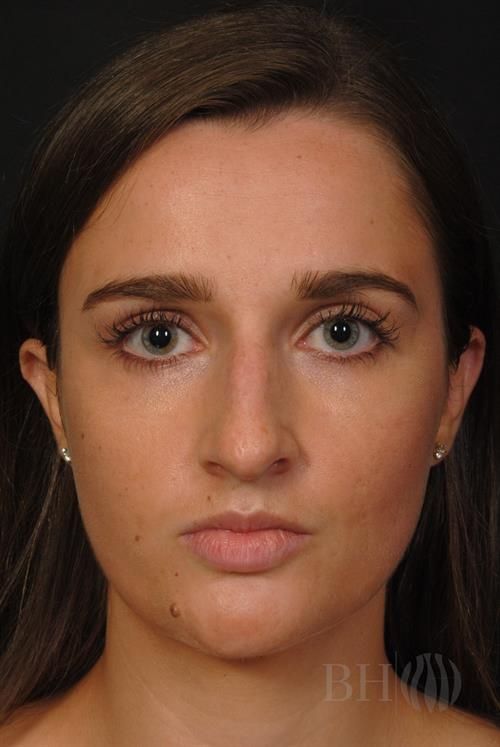Rhinoplasty Before & After