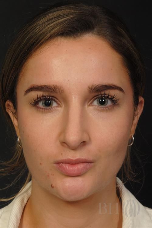 Rhinoplasty Before & After