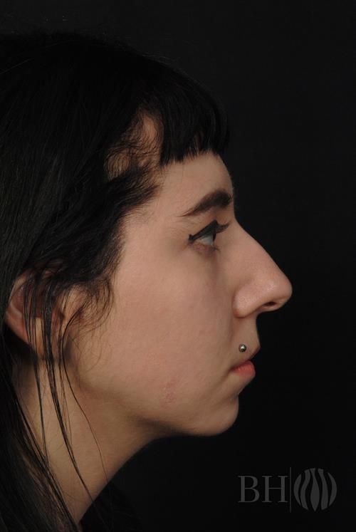 Rhinoplasty Before & After