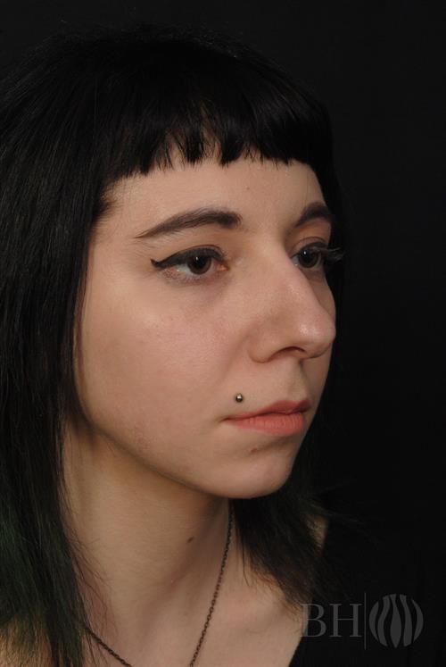 Rhinoplasty Before & After