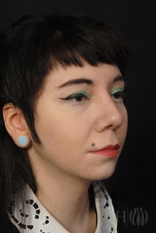 Rhinoplasty Before & After