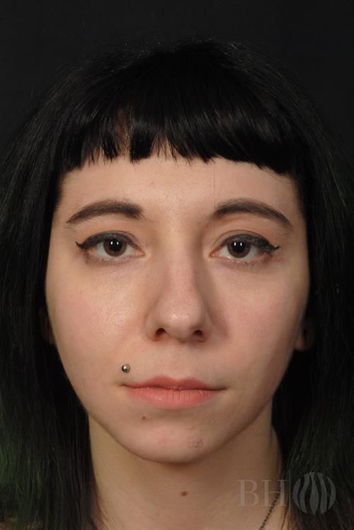 Rhinoplasty Before & After