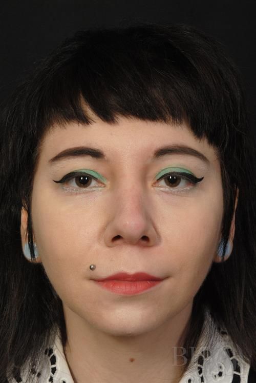 Rhinoplasty Before & After