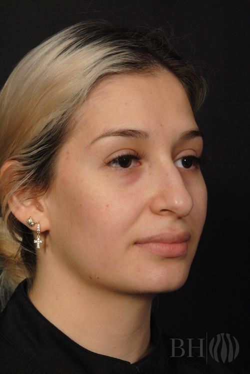 Rhinoplasty Before & After