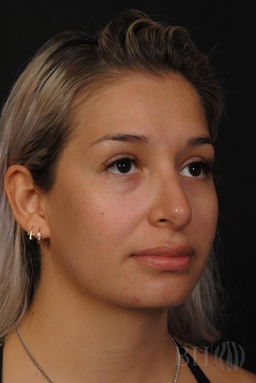 Rhinoplasty Before & After