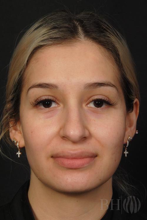 Rhinoplasty Before & After