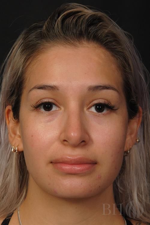 Rhinoplasty Before & After