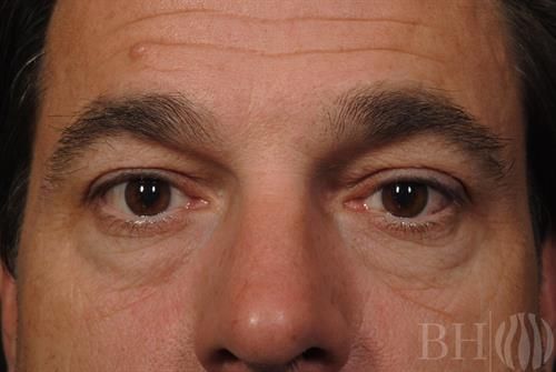 Eyelid Lift Before & After