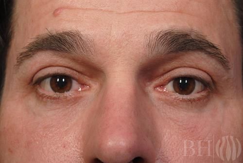 Eyelid Lift Before & After