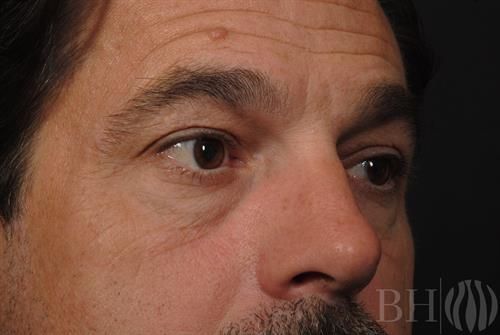 Eyelid Lift Before & After