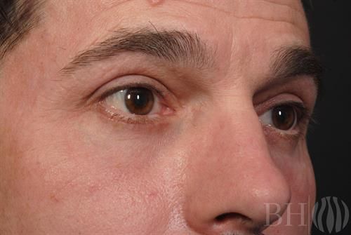 Eyelid Lift Before & After