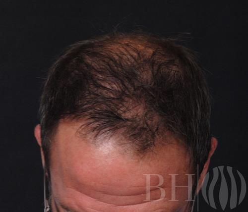 Neograft Hair Restoration Before & After