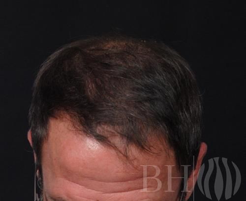 Neograft Hair Restoration Before & After