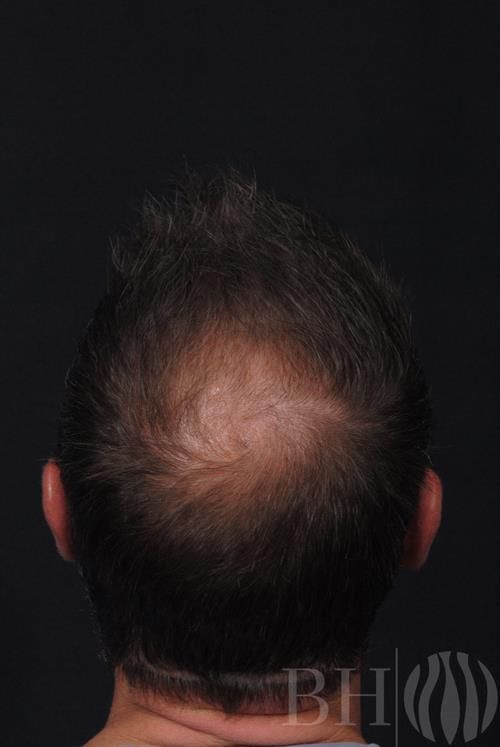 Neograft Hair Restoration Before & After