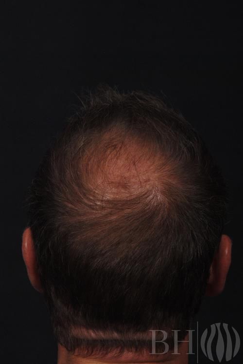 Neograft Hair Restoration Before & After