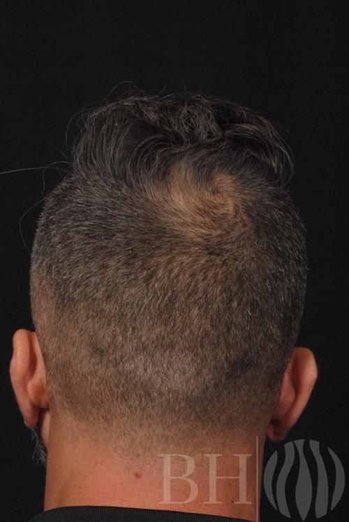 Neograft Hair Restoration Before & After