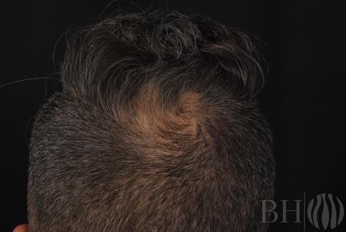 Neograft Hair Restoration Before & After