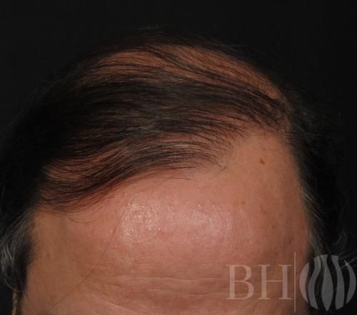 Neograft Hair Restoration Before & After