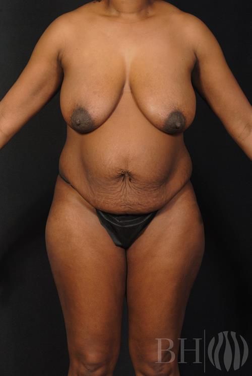 Mommy Makeover Before & After