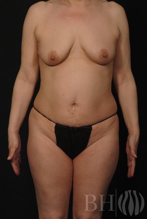 Mommy Makeover Before & After