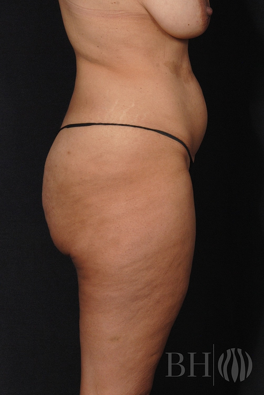 Mommy Makeover Before & After