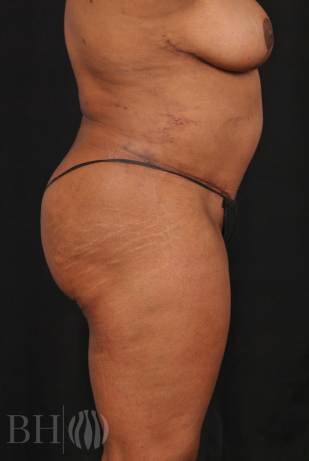 Mommy Makeover Before & After