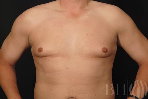 Male Breast Reduction Before & After