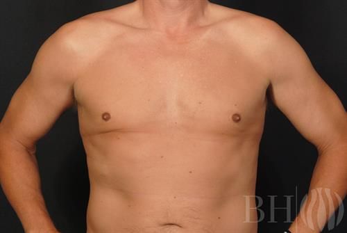 Male Breast Reduction Before & After