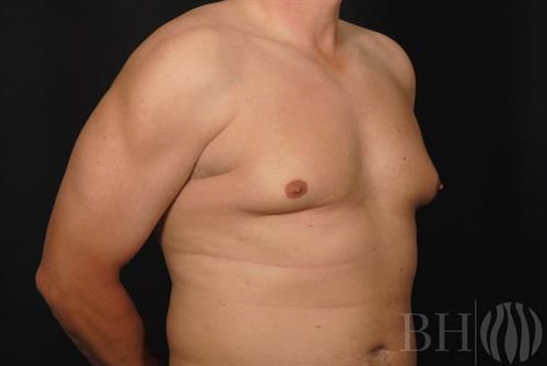 Male Breast Reduction Before & After