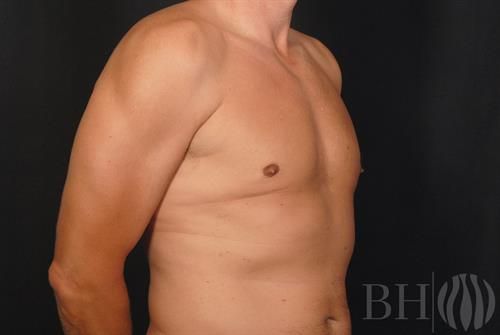 Male Breast Reduction Before & After