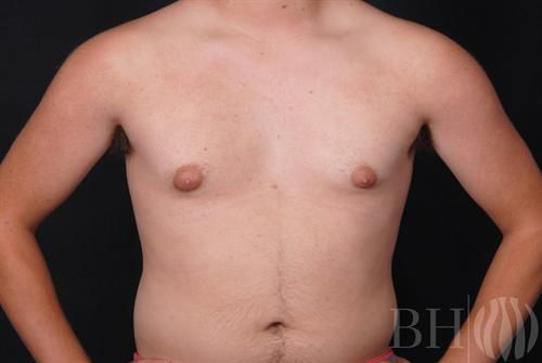 Male Breast Reduction Before & After
