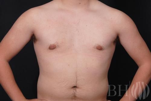 Male Breast Reduction Before & After