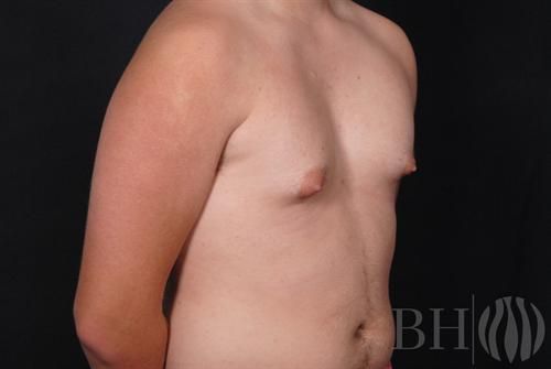 Male Breast Reduction Before & After