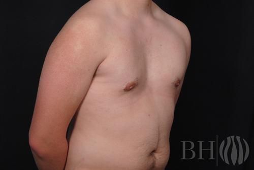 Male Breast Reduction Before & After
