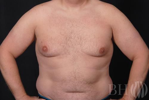 Male Breast Reduction Before & After