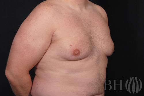 Male Breast Reduction Before & After
