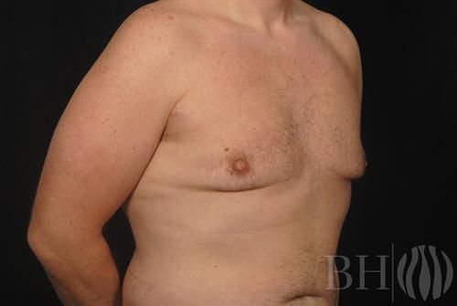 Male Breast Reduction Before & After