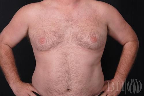 Male Breast Reduction Before & After