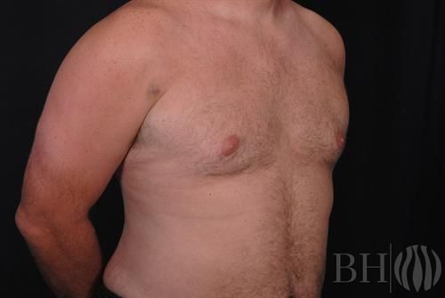 Male Breast Reduction Before & After