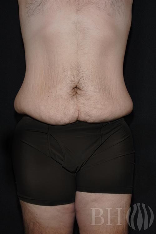 Body Lift Before & After