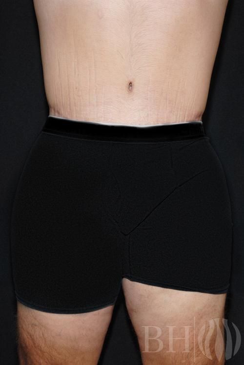 Body Lift Before & After