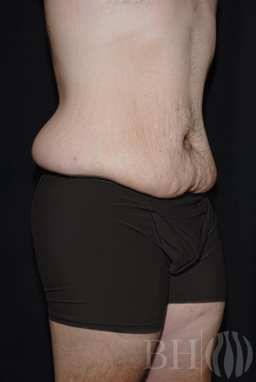 Body Lift Before & After